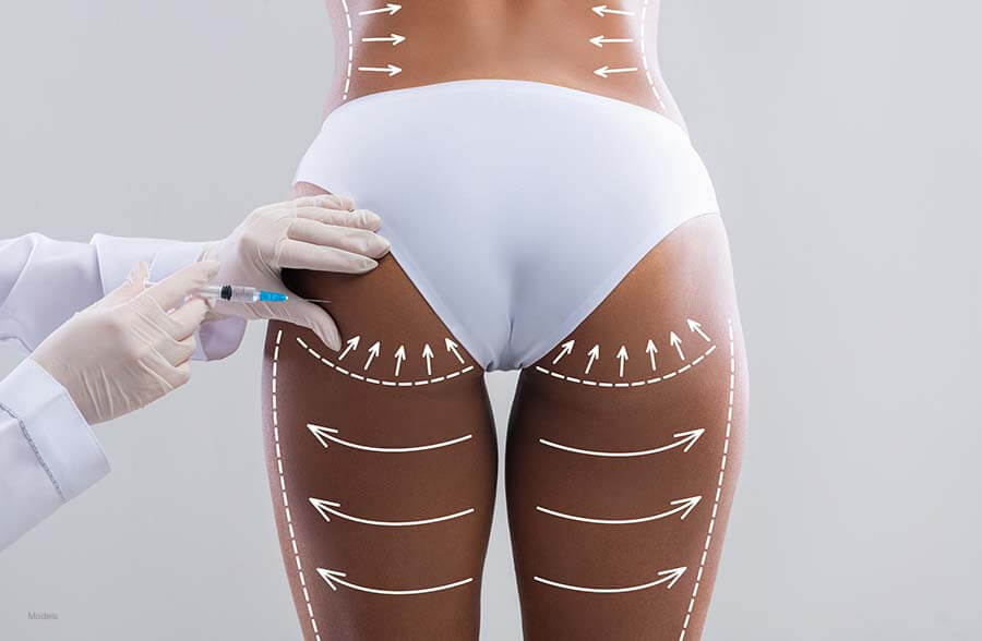 Buttock Sculpting