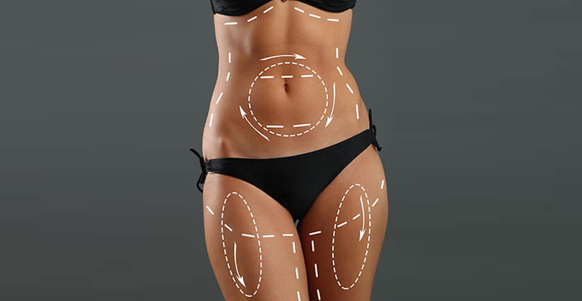 Liposuction
