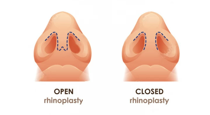 Open Rhinoplasty