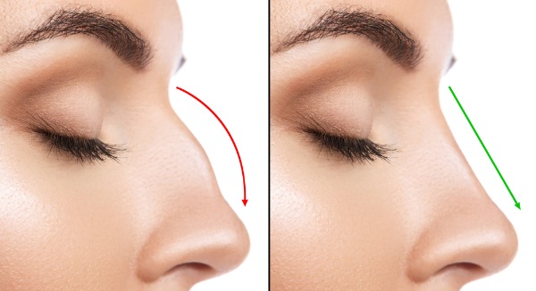 Preservation Rhinoplasty
